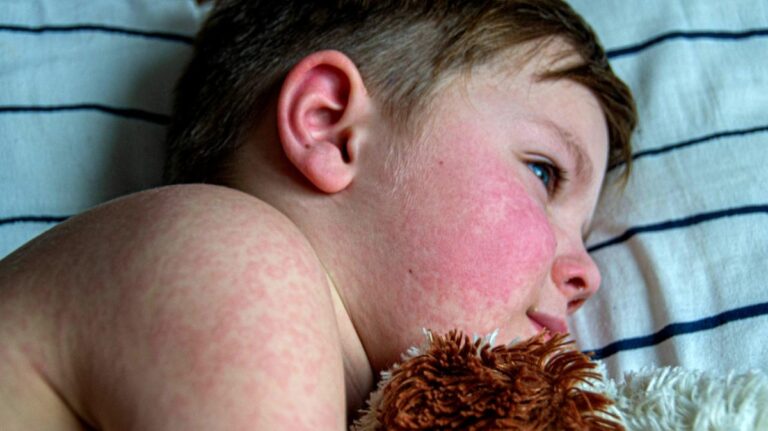 Queda da cobertura vacinal gera alerta para volta do sarampo